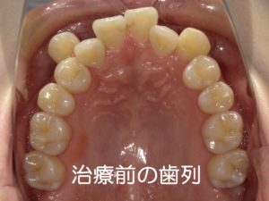 矯正治療で抜歯は必要 島歯科 矯正歯科